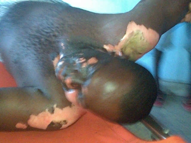 GPL technician shocked, burnt