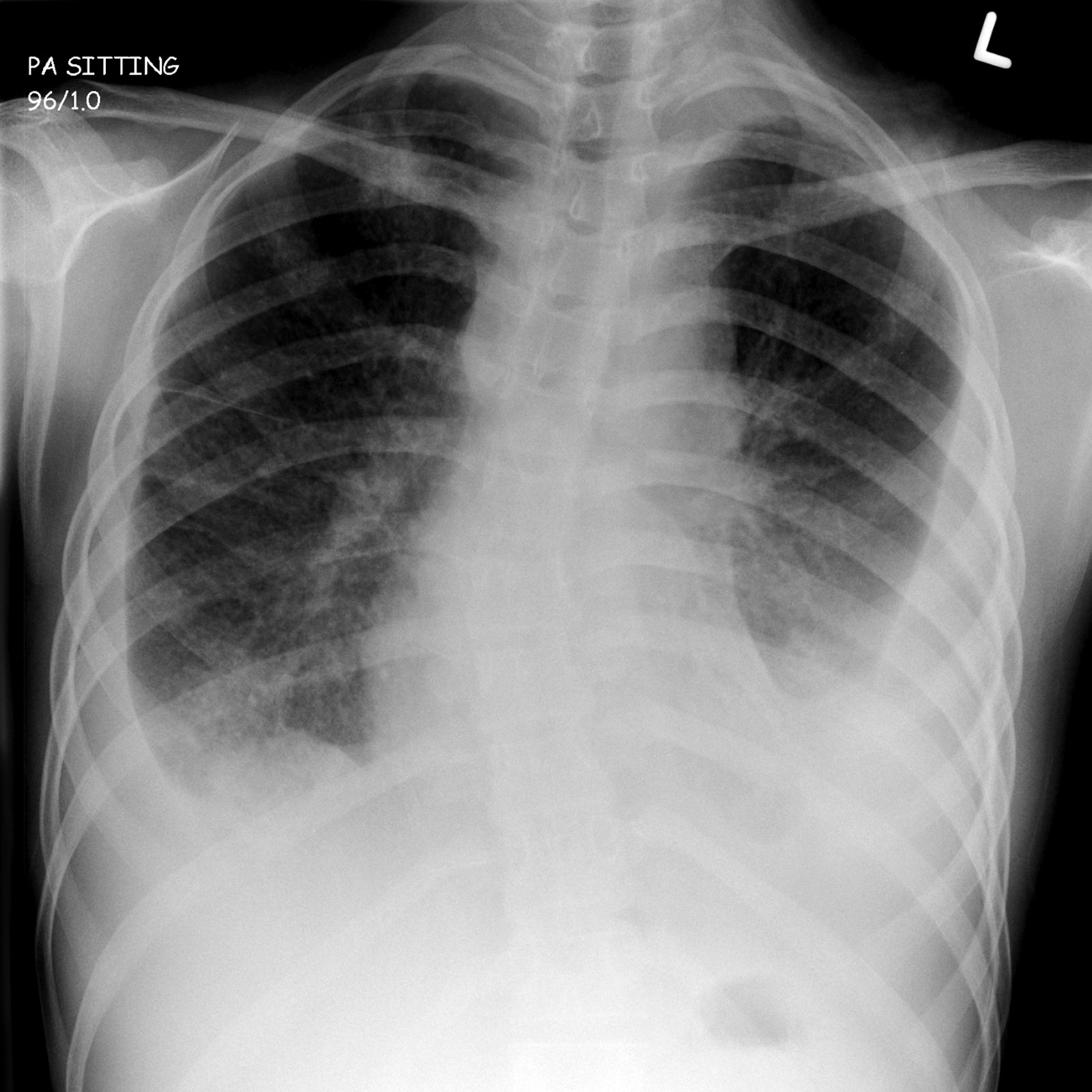 Guyana’s TB incidence declining