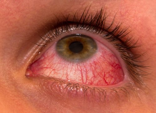 Community Health Centres ready to deal with increased cases of ‘Red Eye’
