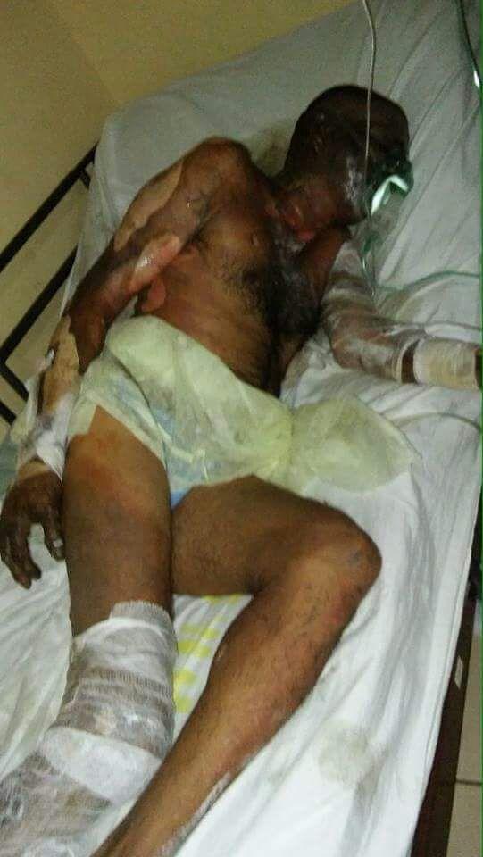 West Coast Berbice man severely burnt in Bushlot mystery fire