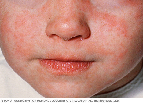 No measles outbreak in Region One – Public Health officials