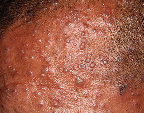 Chicken pox outbreak at Lusignan Prison; APNU+AFC, govt at odds over response