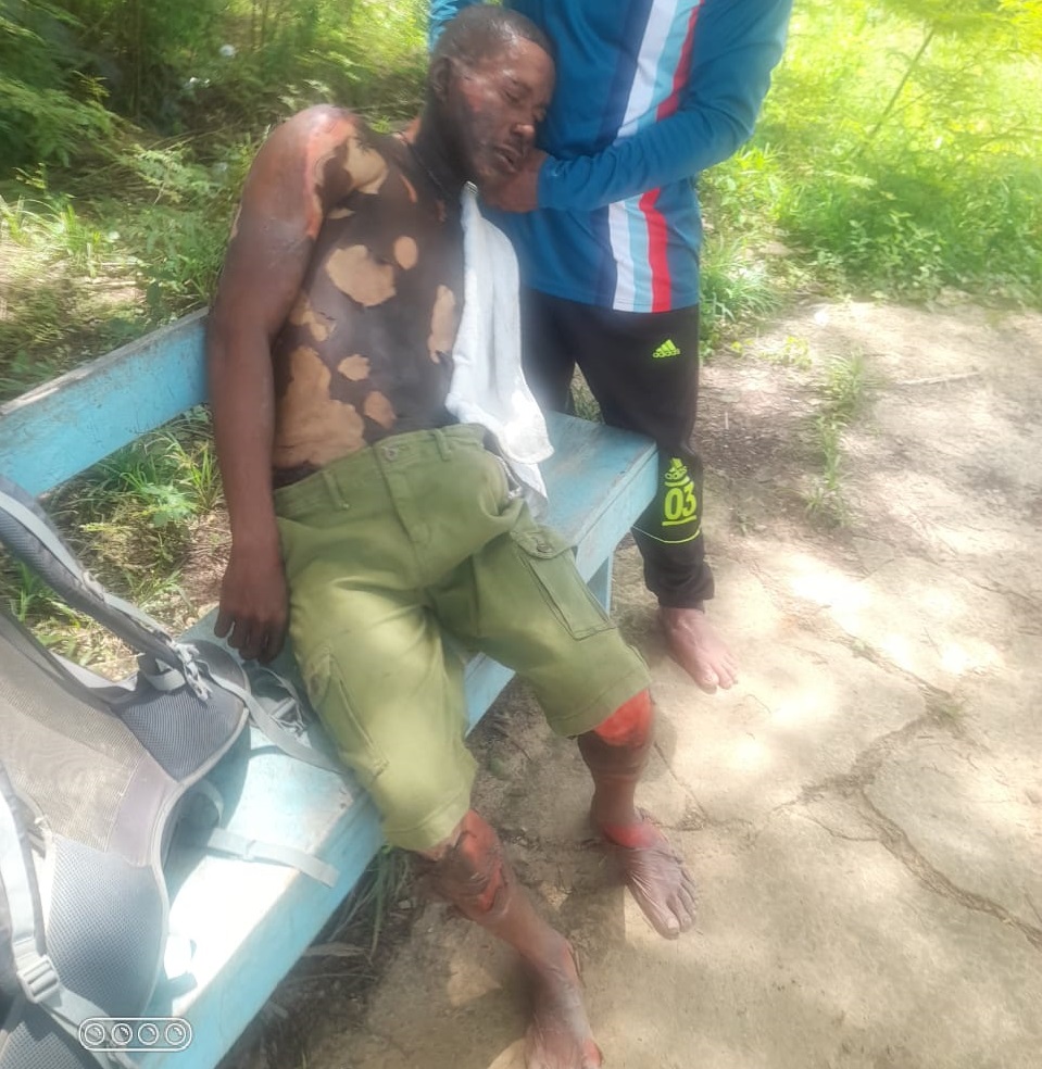 Venezuelan burns gold miner during argument over a female